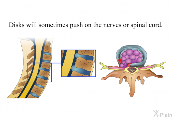 Disks will sometimes push on the nerves or spinal cord.