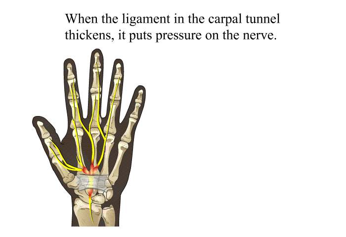 When the ligament in the carpal tunnel thickens, it puts pressure on the nerve.
