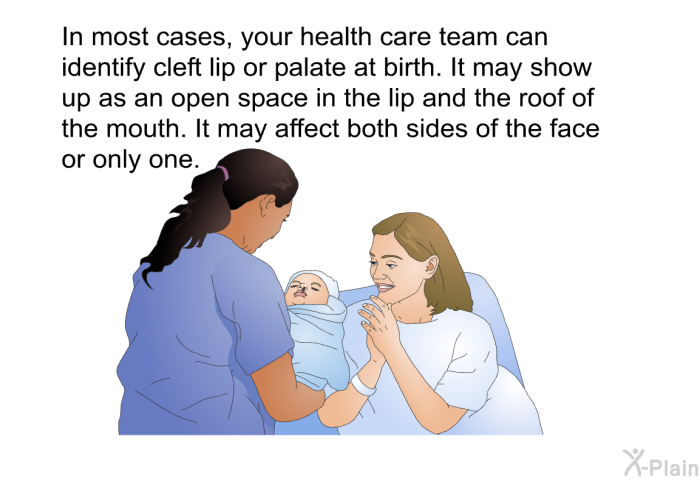 In most cases, your health care team can identify cleft lip or palate at birth. It may show up as an open space in the lip and the roof of the mouth. It may affect both sides of the face or only one.