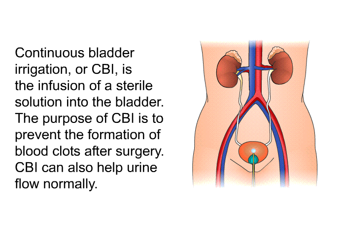 Continuous bladder irrigation, or CBI, is the infusion of a sterile solution into the bladder. The purpose of CBI is to prevent the formation of blood clots after surgery. CBI can also help urine flow normally.