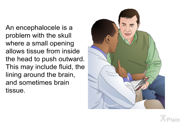 An encephalocele is a problem with the skull where a small opening allows tissue from inside the head to push outward. This may include fluid, the lining around the brain, and sometimes brain tissue.