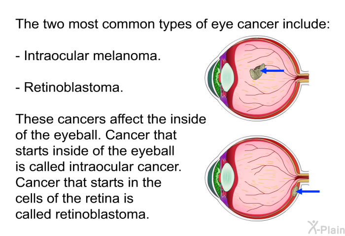 The two most common types of eye cancer include:  Intraocular melanoma. Retinoblastoma.  
 These cancers affect the inside of the eyeball. Cancer that starts inside of the eyeball is called intraocular cancer. Cancer that starts in the cells of the retina is called retinoblastoma.