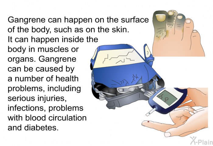 Gangrene can happen on the surface of the body, such as on the skin. It can happen inside the body in muscles or organs. Gangrene can be caused by a number of health problems, including serious injuries, infections, problems with blood circulation and diabetes.