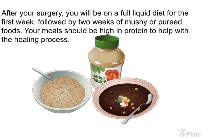 After your surgery, you will be on a full liquid diet for the first week, followed by two weeks of mushy or pureed foods. Your meals should be high in protein to help with the healing process.