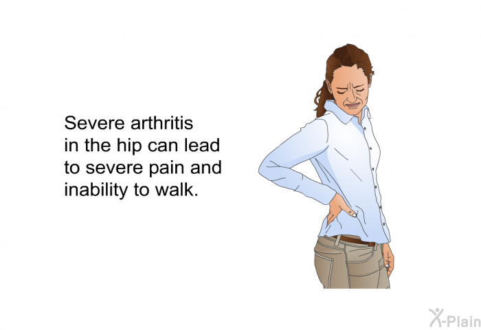 Severe arthritis in the hip can lead to severe pain and inability to walk.