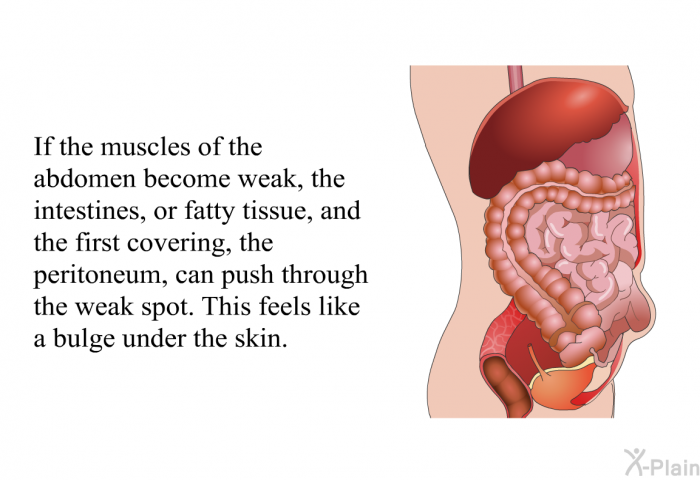 If the muscles of the abdomen become weak, the intestines, or fatty tissue, and the first covering, the peritoneum, can push through the weak spot. This feels like a bulge under the skin.