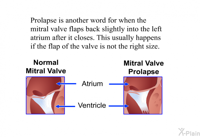 Prolapse is another word for when the mitral valve flaps back slightly into the left atrium after it closes. This usually happens if the flap of the valve is not the right size.