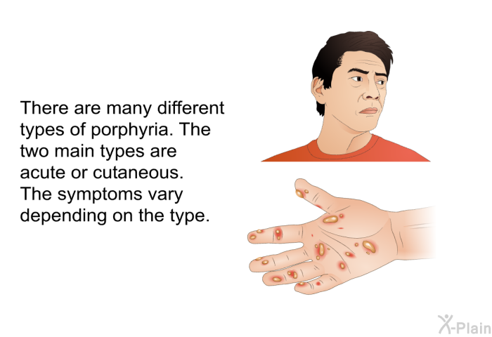 There are many different types of porphyria. The two main types are acute or cutaneous. The symptoms vary depending on the type.