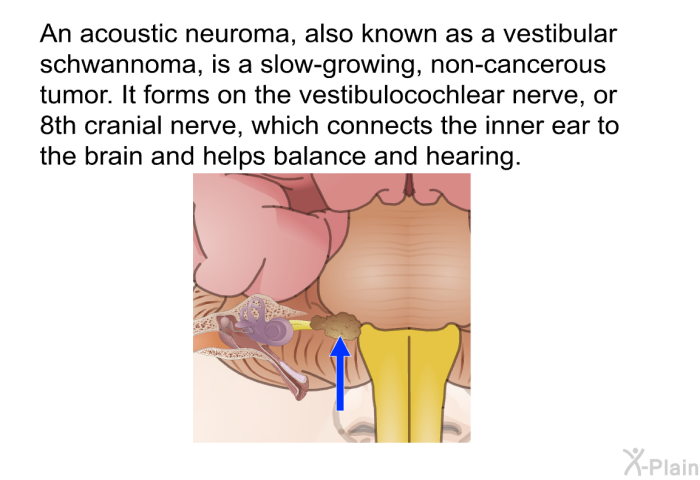 An acoustic neuroma, also known as a vestibular schwannoma, is a slow-growing, non-cancerous tumor. It forms on the vestibulocochlear nerve, or 8th cranial nerve, which connects the inner ear to the brain and helps balance and hearing.