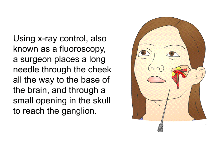 Using x-ray control, also known as a fluoroscopy, a surgeon places a long needle through the cheek all the way to the base of the brain, and through a small opening in the skull to reach the ganglion.