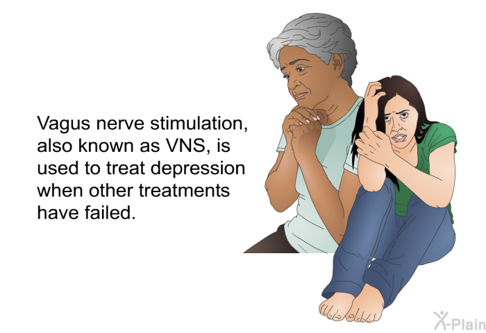 Vagus nerve stimulation, also known as VNS, is used to treat depression when other treatments have failed.