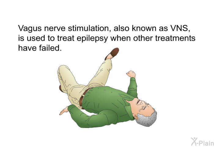 Vagus nerve stimulation, also known as VNS, is used to treat epilepsy when other treatments have failed.