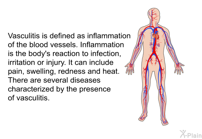 Vasculitis is defined as inflammation of the blood vessels. Inflammation is the body's reaction to infection, irritation or injury. It can include pain, swelling, redness and heat. There are several diseases characterized by the presence of vasculitis.