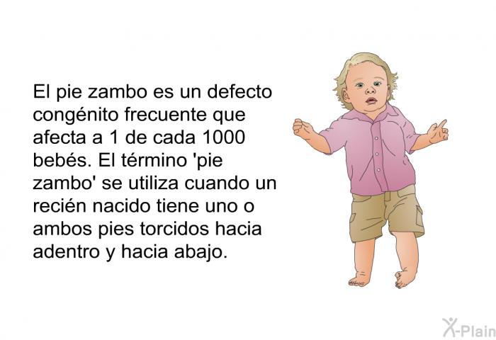 El pie zambo es un defecto congnito frecuente que afecta a 1 de cada 1000 bebs. El trmino  pie zambo' se utiliza cuando un recin nacido tiene uno o ambos pies torcidos hacia adentro y hacia abajo.