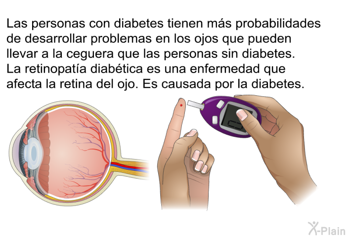 Las personas con diabetes tienen ms probabilidades de desarrollar problemas en los ojos que pueden llevar a la ceguera que las personas sin diabetes. La retinopata diabtica es una enfermedad que afecta la retina del ojo. Es causada por la diabetes.