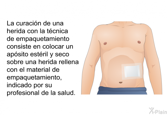 La curacin de una herida con la tcnica de empaquetamiento consiste en colocar un apsito estril y seco sobre una herida rellena con el material de empaquetamiento, indicado por su profesional de la salud.