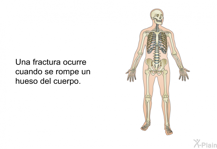 Una fractura ocurre cuando se rompe un hueso del cuerpo.