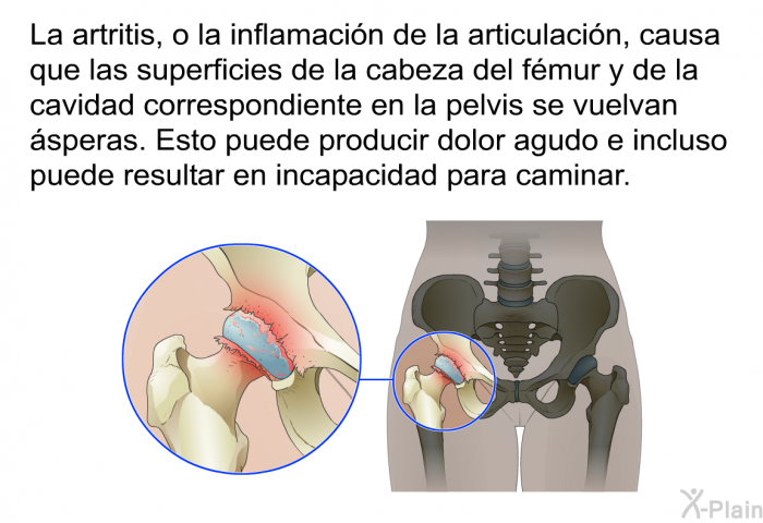 La artritis, o la inflamacin de la articulacin, causa que las superficies de la cabeza del fmur y de la cavidad correspondiente en la pelvis se vuelvan speras. Esto puede producir dolor agudo e incluso puede resultar en incapacidad para caminar.