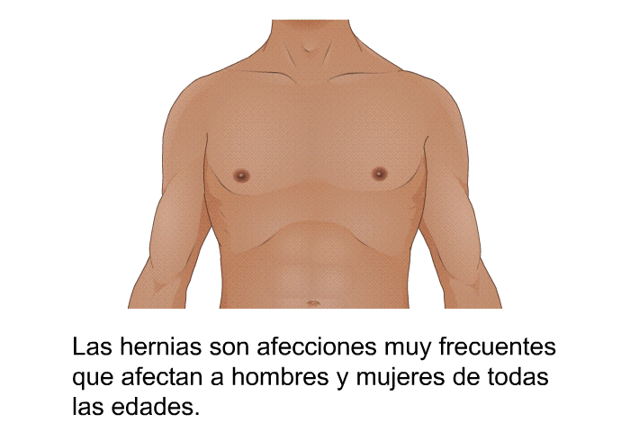 Las hernias son afecciones muy frecuentes que afectan a hombres y mujeres de todas las edades.