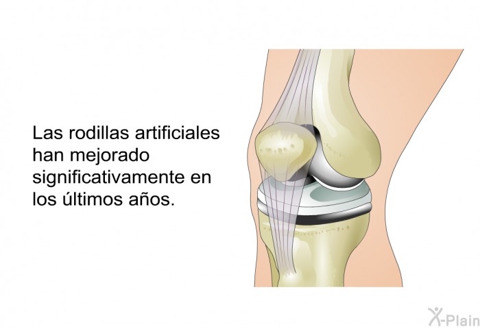 Las rodillas artificiales han mejorado significativamente en los ltimos aos.