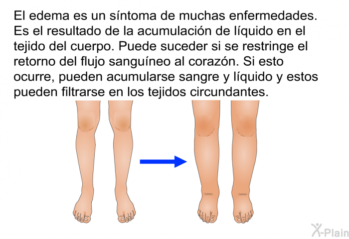 El edema es un sntoma de muchas enfermedades. Es el resultado de la acumulacin de lquido en el tejido del cuerpo. Puede suceder si se restringe el retorno del flujo sanguneo al corazn. Si esto ocurre, pueden acumularse sangre y lquido y estos pueden filtrarse en los tejidos circundantes.