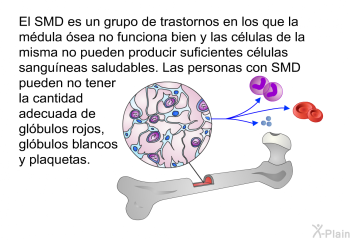 El SMD es un grupo de trastornos en los que la mdula sea no funciona bien y las clulas de la misma no pueden producir suficientes clulas sanguneas saludables. Las personas con SMD pueden no tener la cantidad adecuada de glbulos rojos, glbulos blancos y plaquetas.