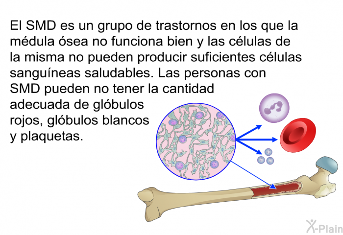 El SMD es un grupo de trastornos en los que la mdula sea no funciona bien y las clulas de la misma no pueden producir suficientes clulas sanguneas saludables. Las personas con SMD pueden no tener la cantidad adecuada de glbulos rojos, glbulos blancos y plaquetas.