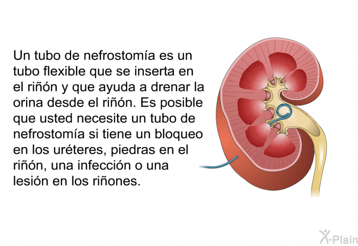 Un tubo de nefrostoma es un tubo flexible que se inserta en el rin y que ayuda a drenar la orina desde el rin. Es posible que usted necesite un tubo de nefrostoma si tiene un bloqueo en los urteres, piedras en el rin, una infeccin o una lesin en los riones.