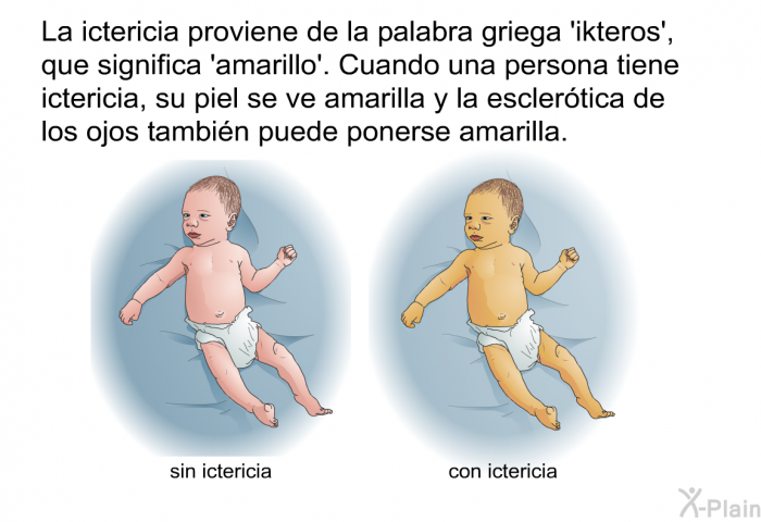 La ictericia proviene de la palabra griega  <I>ikteros</I>', que significa  amarillo'. Cuando una persona tiene ictericia, su piel se ve amarilla y la esclertica de los ojos tambin puede ponerse amarilla.