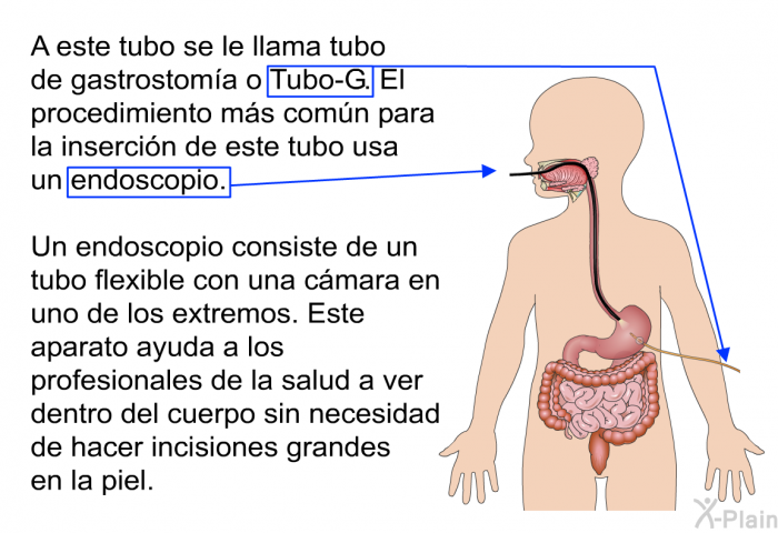 A este tubo se le llama tubo de gastrostoma o Tubo-G. El procedimiento ms comn para la insercin de este tubo usa un endoscopio. Un endoscopio consiste de un tubo flexible con una cmara en uno de los extremos. Este aparato ayuda a los profesionales de la salud a ver dentro del cuerpo sin necesidad de hacer incisiones grandes en la piel.