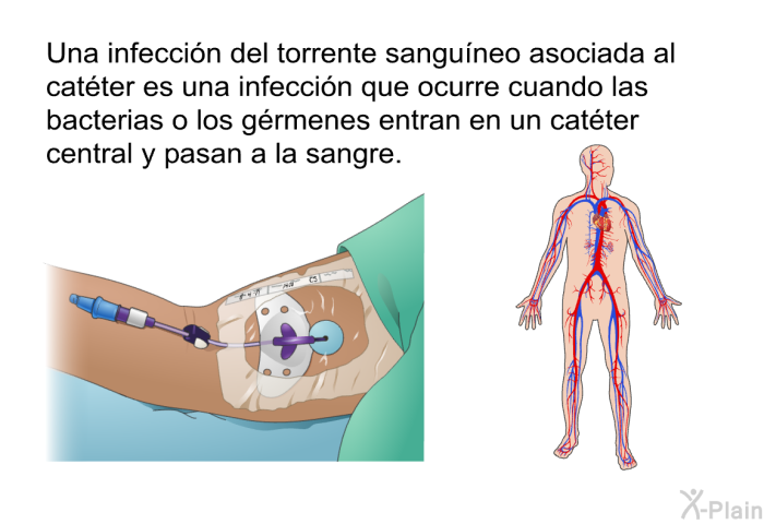 Una infeccin del torrente sanguneo asociada al catter es una infeccin que ocurre cuando las bacterias o los grmenes entran en un catter central y pasan a la sangre.