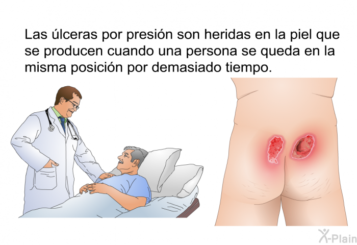 Las lceras por presin son heridas en la piel que se producen cuando una persona se queda en la misma posicin por demasiado tiempo.