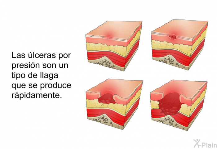 Las lceras por presin son un tipo de llaga que se produce rpidamente.