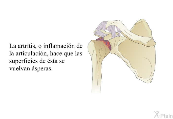 La artritis, o inflamacin de la articulacin, hace que las superficies de sta se vuelvan speras.