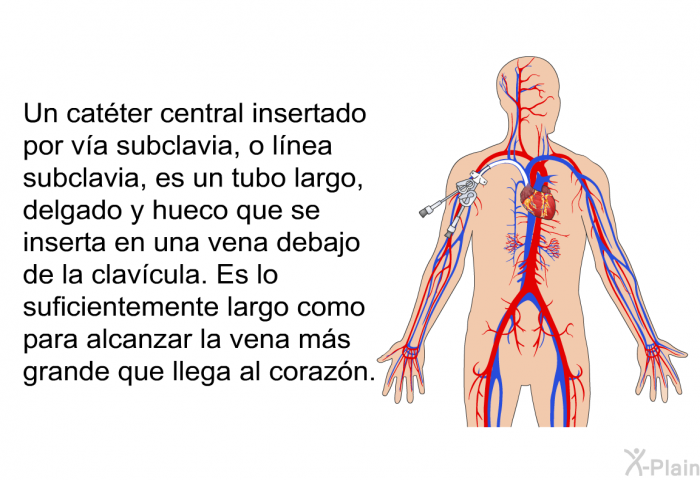 Un catter central insertado por va subclavia, o lnea subclavia, es un tubo largo, delgado y hueco que se inserta en una vena debajo de la clavcula. Es lo suficientemente largo como para alcanzar la vena ms grande que llega al corazn.