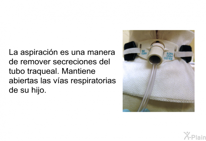 La aspiracin es una manera de remover secreciones del tubo traqueal. Mantiene abiertas las vas respiratorias de su hijo.