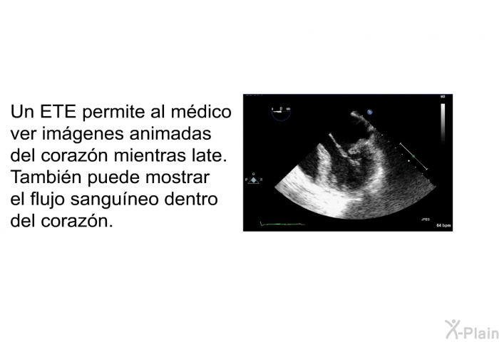 Un ETE permite al mdico ver imgenes animadas del corazn mientras late. Tambin puede mostrar el flujo sanguneo dentro del corazn.