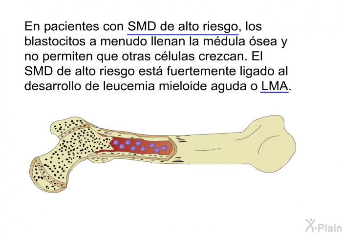 En pacientes con SMD de alto riesgo, los blastocitos a menudo llenan la mdula sea y no permiten que otras clulas crezcan. El SMD de alto riesgo est fuertemente ligado al desarrollo de leucemia mieloide aguda o LMA.