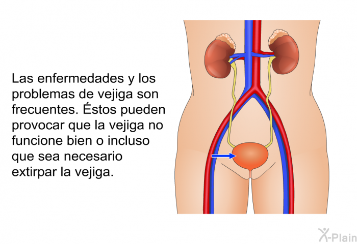 Las enfermedades y los problemas de vejiga son frecuentes. Éstos pueden provocar que la vejiga no funcione bien o incluso que sea necesario extirpar la vejiga.