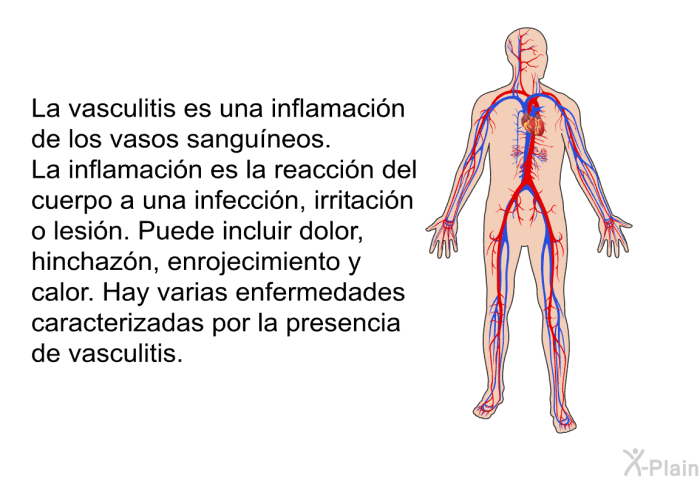 La vasculitis es una inflamacin de los vasos sanguneos. La inflamacin es la reaccin del cuerpo a una infeccin, irritacin o lesin. Puede incluir dolor, hinchazn, enrojecimiento y calor. Hay varias enfermedades caracterizadas por la presencia de vasculitis.