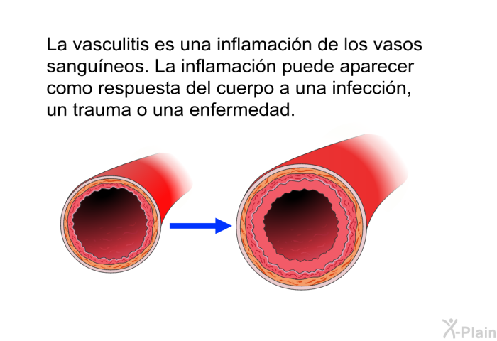 La vasculitis es una inflamacin de los vasos sanguneos. La inflamacin puede aparecer como respuesta del cuerpo a una infeccin, un trauma o una enfermedad.