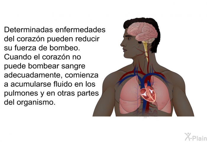 Determinadas enfermedades del corazn pueden reducir su fuerza de bombeo. Cuando el corazn no puede bombear sangre adecuadamente, comienza a acumularse fluido en los pulmones y en otras partes del organismo.