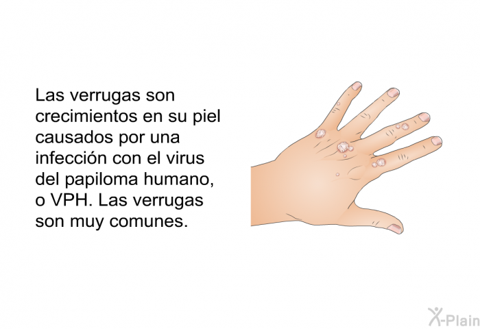 Las verrugas son crecimientos en su piel causados por una infeccin con el virus del papiloma humano, o VPH. Las verrugas son muy comunes.